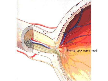 Glaucoma_And_Treatment3.jpg