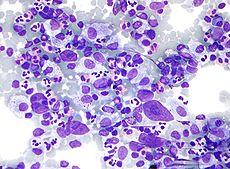 Hodgkin_lymphoma.jpg